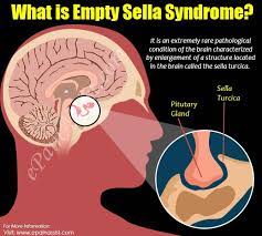ESS, Emptty Sella Syndrome, Syndrome Otak, Ruben Onsu ESS, Apa ESS?, APa Empty Sella Syndrome?,
