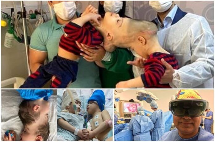 Operasi Realitas Virtual, Bayi Kembar Siam, Kembar Siam, Brazil, Cranioparagus, Operasi
